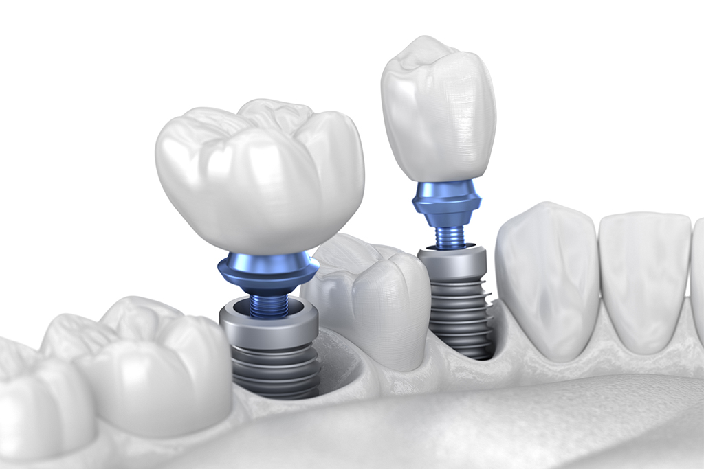 噛める義歯をお探しならインプラント
